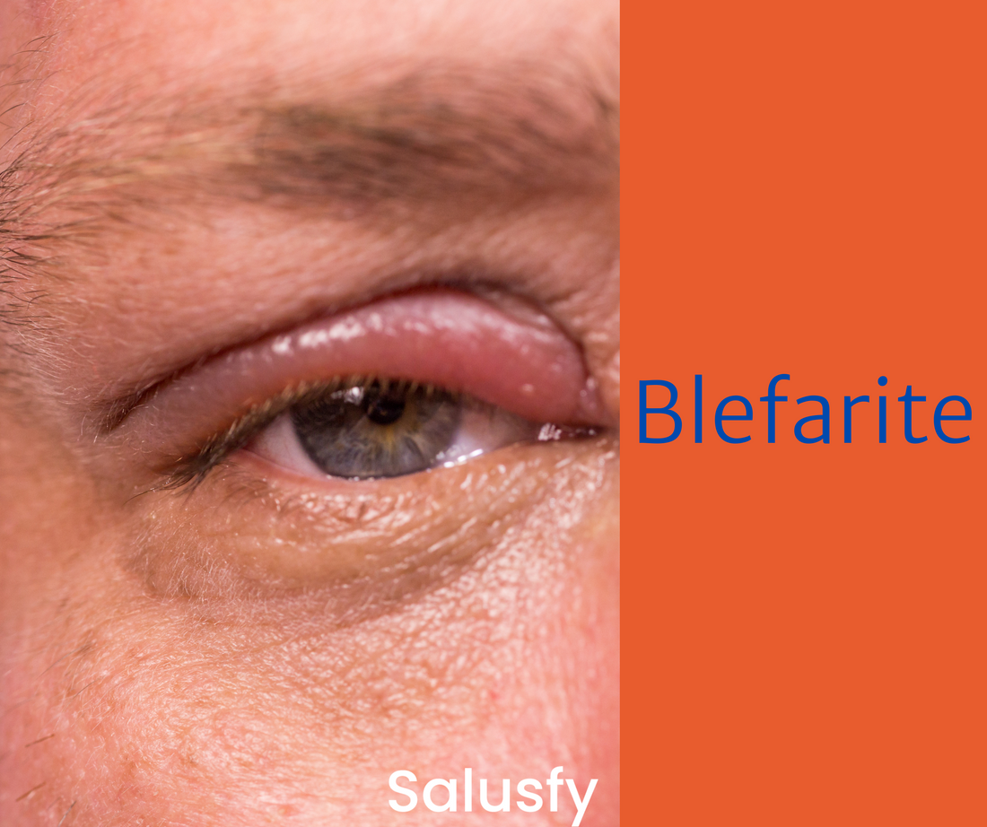 Blefarite: come eliminarla completamente